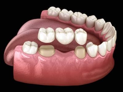 Dental Bridge in Watkinsville, GA