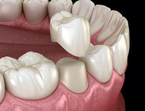 dental crown in Watkinsville, GA