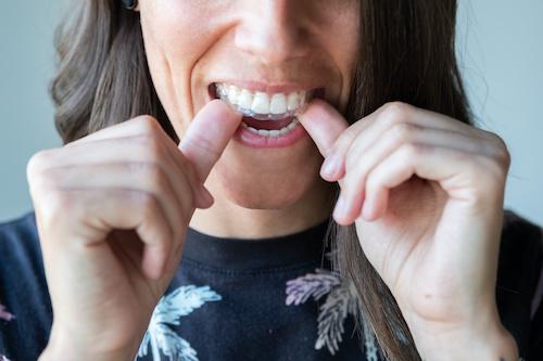 ClearCorrect Invisible Braces in Watkinsville, GA
