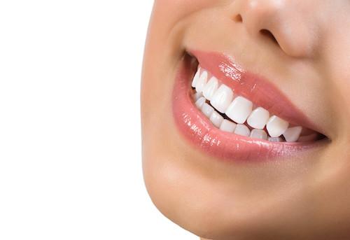 woman smiling with dental crowns