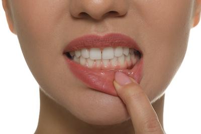 woman with gum disease