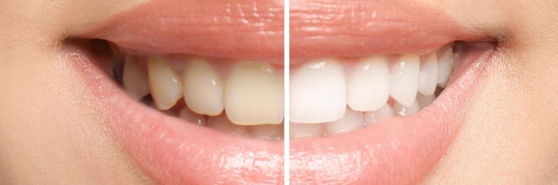 before and after teeth whitening