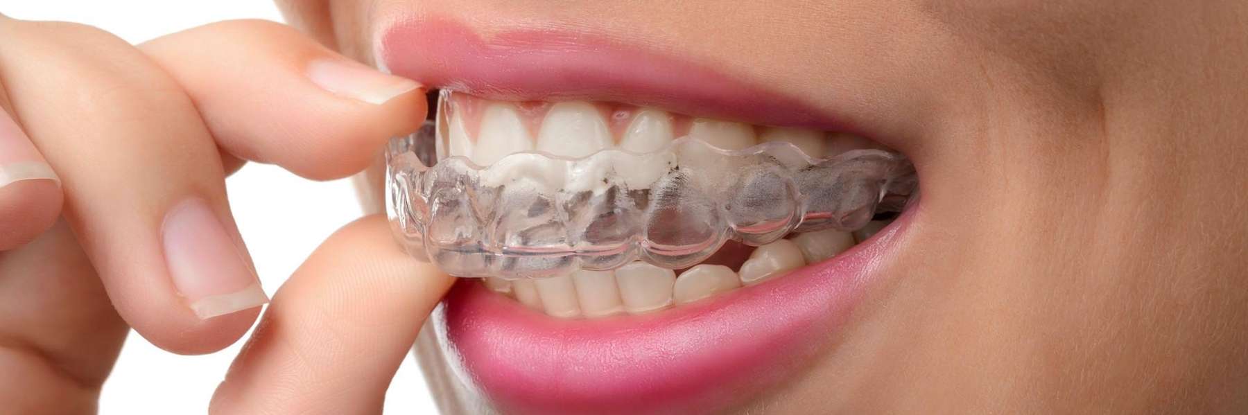 holding Invisalign® inside the mouth
