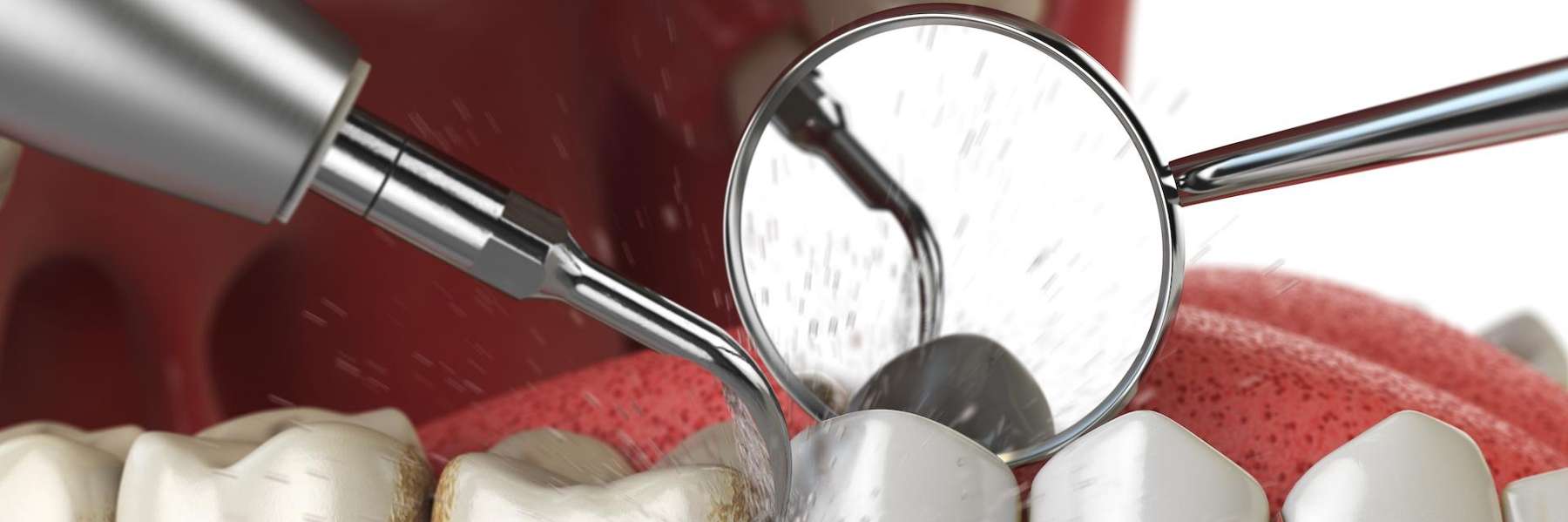 dental cleaning in Watkinsville GA