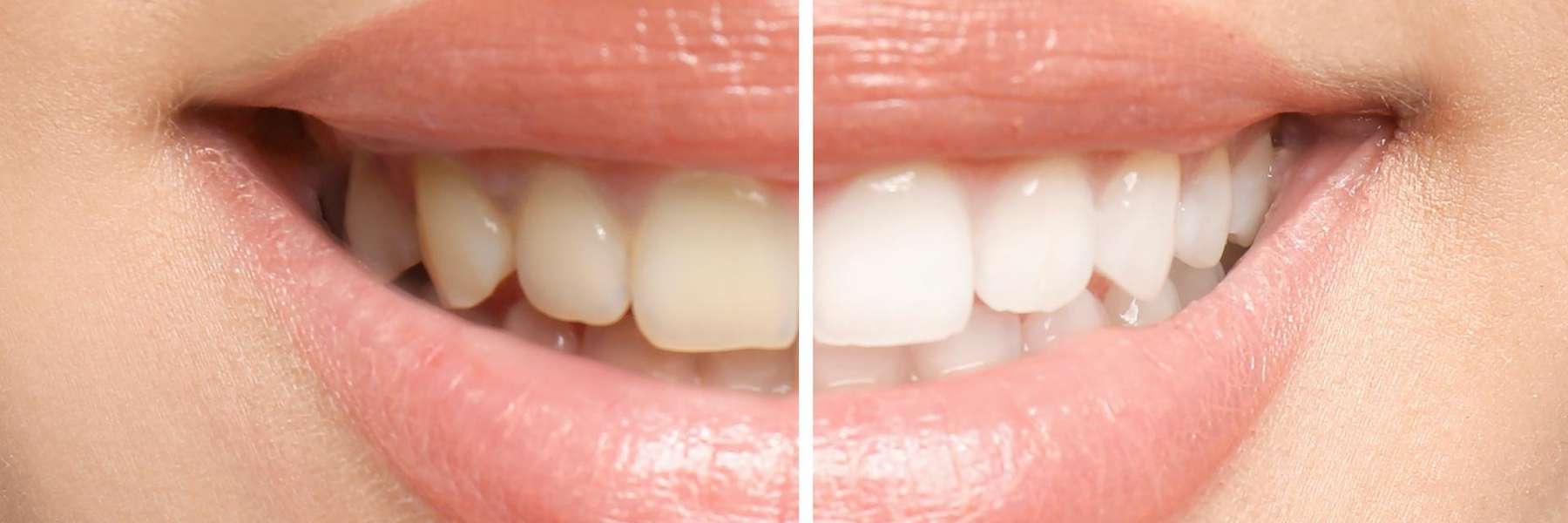 before and after teeth whitening