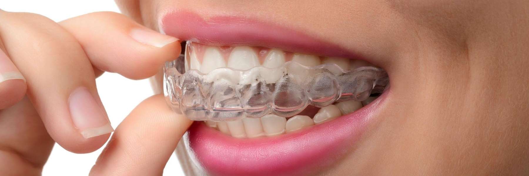 invisalign aligners in the mouth