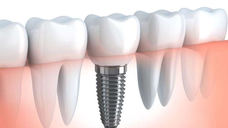 dental implant post illustration
