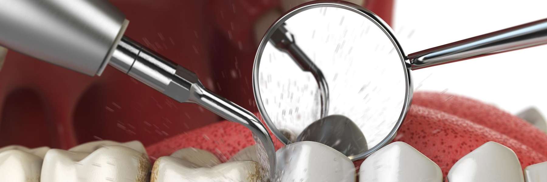 dental cleaning tools