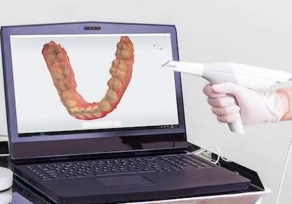 digital impressions | watkinsville dentist