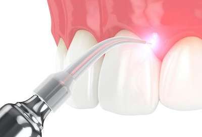 soft tissue laser | watkinsville dentist