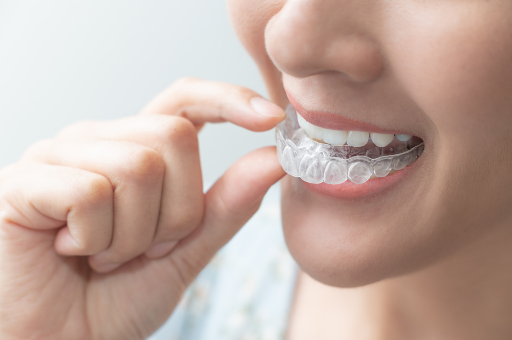 is invisalign noticeable